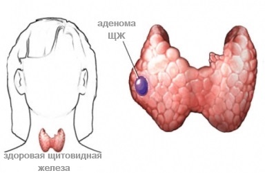 Can a node dissolve in the thyroid gland