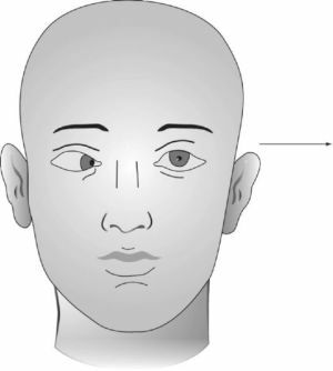 paresia facial
