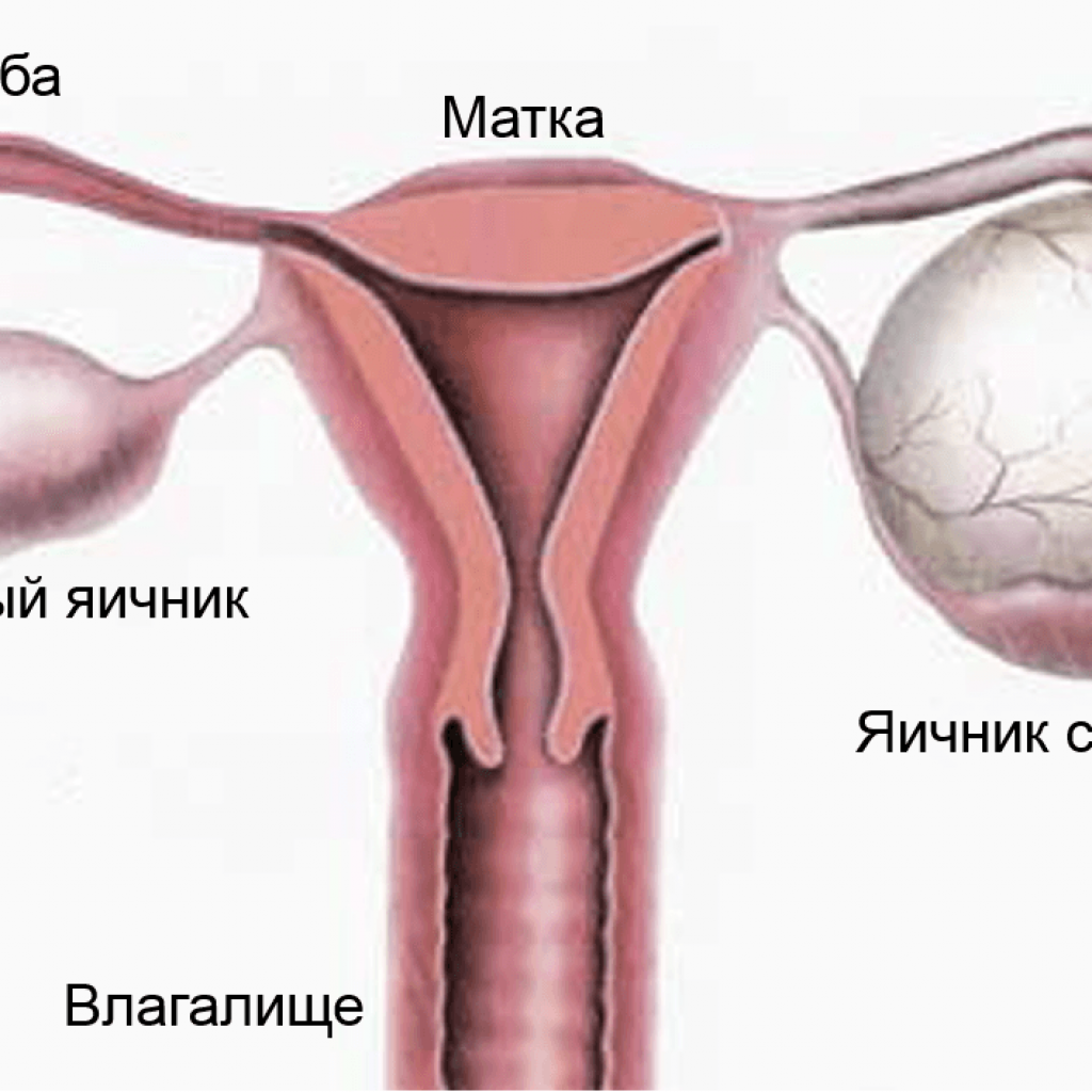 Ovariecystatom
