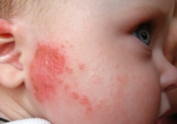 Che aspetto ha l'allergia nei bambini?