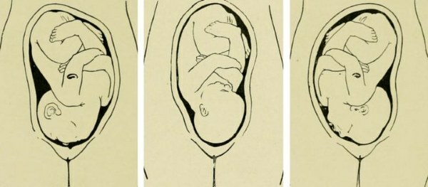 Cephalic presentation of the fetus at 20-30 weeks of gestation