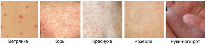 Rubella rash. Photo, diff. diagnosis, diagnosis
