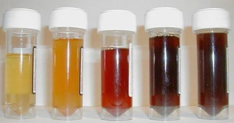 Brown urine in women. Causes for cystitis, pregnancy, menopause, treatment