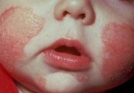 Allergie gegen Protein bei Kindern( auf dem Protein der Kuhmilch)