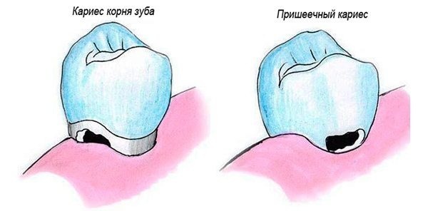 Cervical caries. Treatment, price, causes of occurrence, how quickly it develops