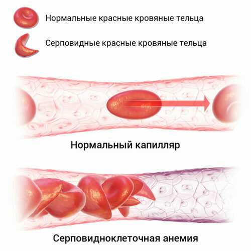 Sorbifer z niską hemoglobiną u dorosłych. Jak zażywać w czasie ciąży