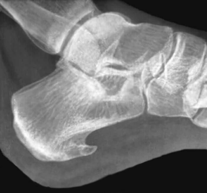 With the spur, patients involuntarily tend to relieve the heel area and less to step on the affected foot