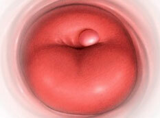 Symptome der Zyste am Gebärmutterhals