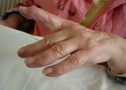 Polyarthritis of the fingers