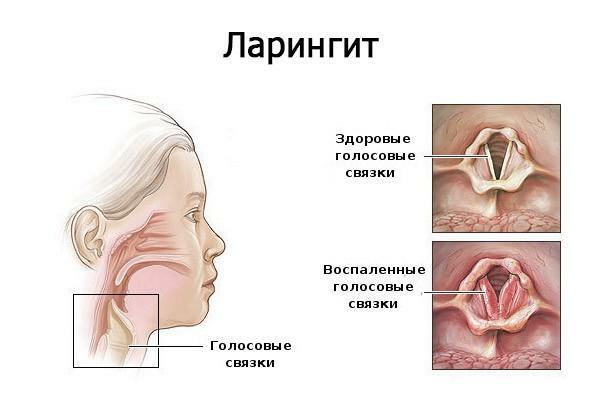Vocal cords with laryngitis