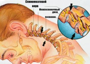 displacement of vertebrae in the neck