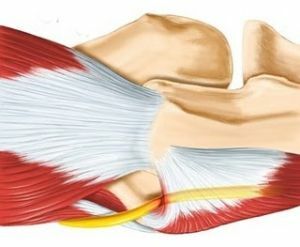 pinching of the ulnar nerve