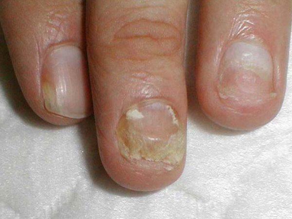 Hvordan virker onychomycosis af negle