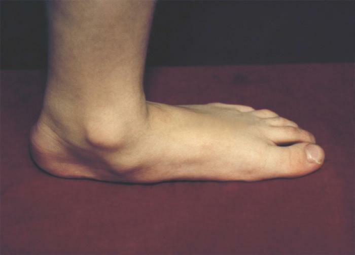 Flat-footedness - bilde