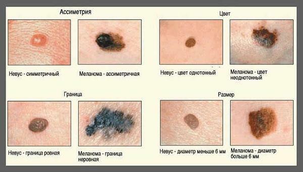 Differences in benign mole from malignant