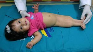 Sirenomelia: developmental features and prognosis for mermaid syndrome