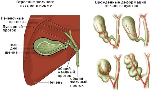 Deformasjon av galleblæren hos en voksen. Hva er det, årsaker, symptomer, behandling