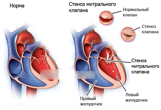 Laste südame läbimõõt. Norm, mis on võrdne aordiklapi puudulikkuse, vatsakeste hüpertroofia, stenoosi korral