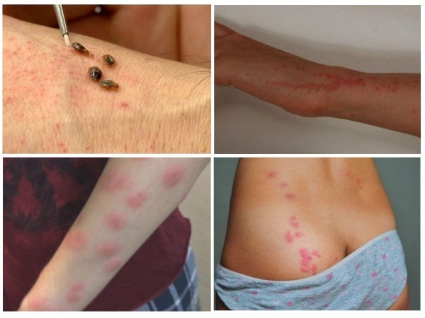 Bedbug bites on humans. Photos, symptoms, how to process, treat, what is fraught with