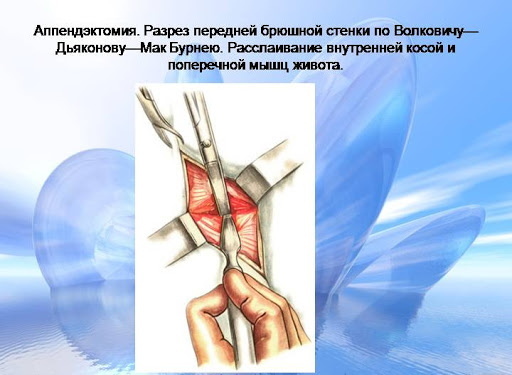 Apendicectomía según Volkovich-Dyakonov por incisión pararrectal según Lenander