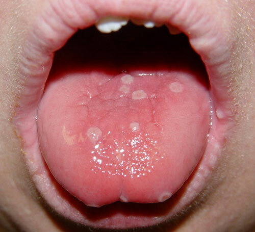 Chickenpox in the mouth. Photo, temperature, how long it takes, treatment