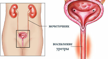 Urethritis in women