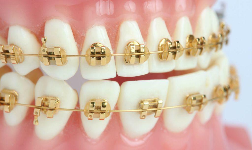 Gold braces