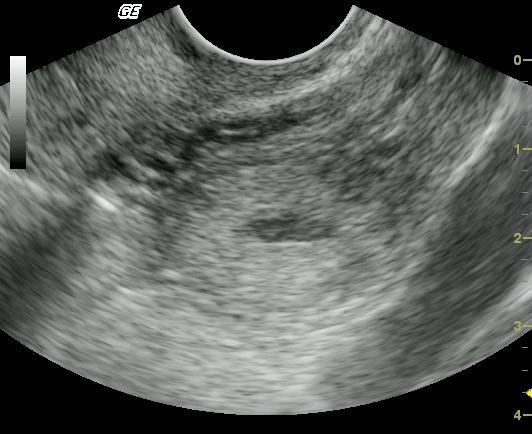 Photo of ultrasound of an ectopic pregnancy