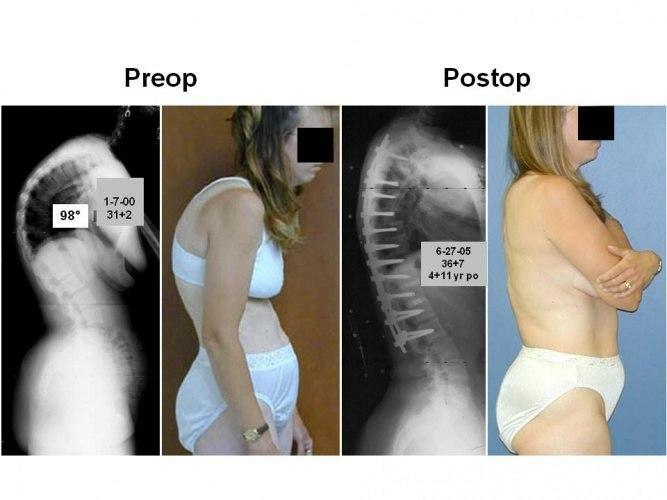 Kyphosis of thoracic spine