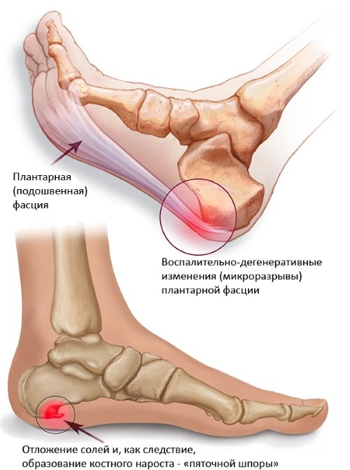 Plantar fasciitis of the foot. Treatment with folk remedies, ointments, gymnastics