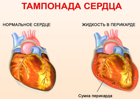 Тампонада сердца что это такое