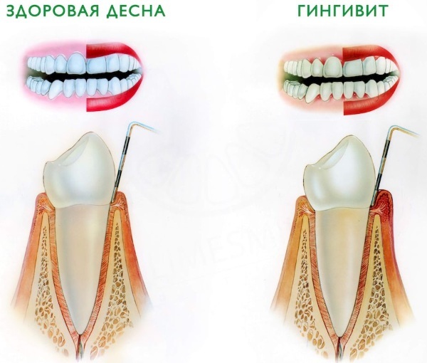 Hvordan tannkjøttet hovner opp når det kommer tenner hos barn