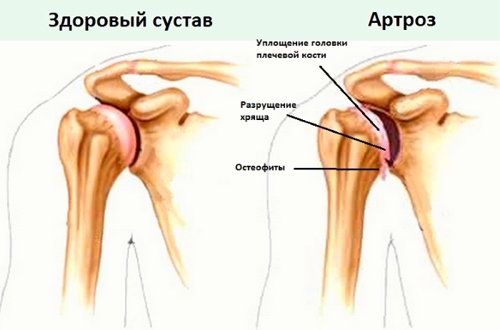Artrosis de la articulación del hombro 1-2-3 grados. Tratamiento, ejercicio, gimnasia, síntomas, signos, dieta