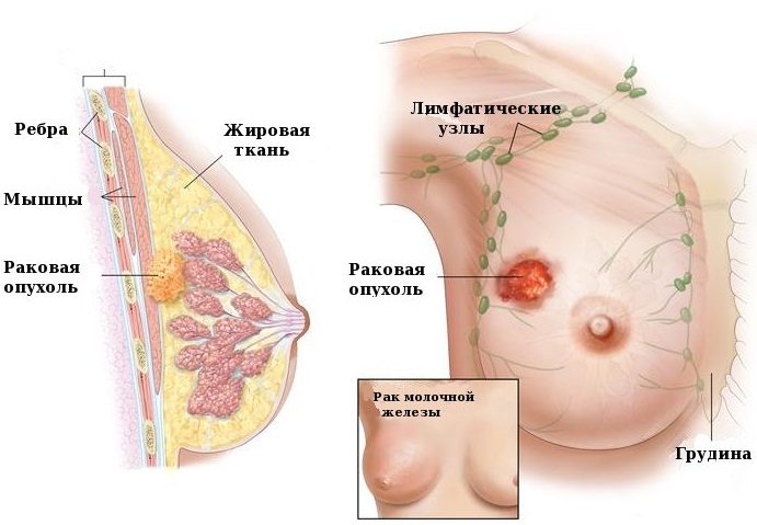breast breast. Symptoms, signs, treatment of folk remedies, herbs