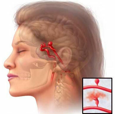 Aneurysma van cerebrale bloedvaten