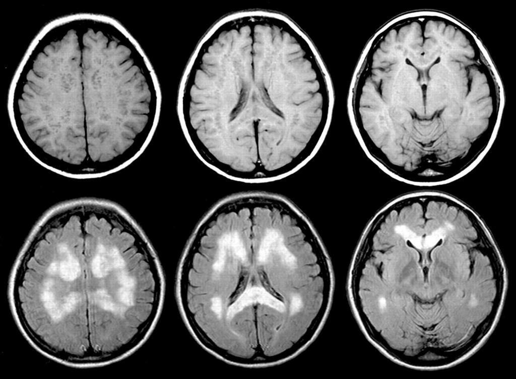Parkinsonova bolest na MRI