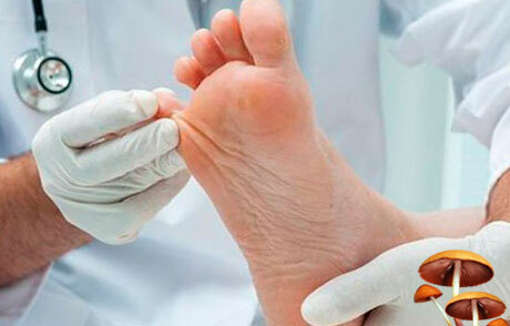 Symptomen en behandeling van voetschimmel, foto