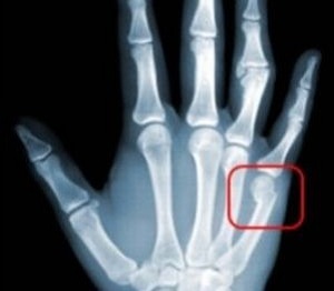 Röntgenfoto na fractuur van de pink op de arm