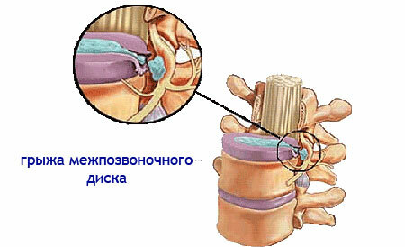 Spondylarthrose av lumbosakral ryggraden