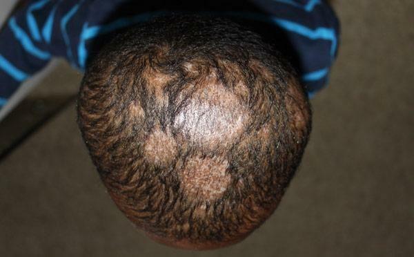 Baldness är ett tecken på ringorm