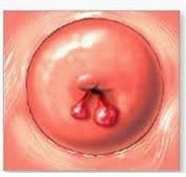 Deux polypes dans le canal cervical