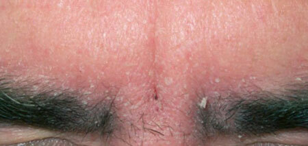 Seborrheic dermatitt på øyenbrynene og ansiktet( bilde 2)