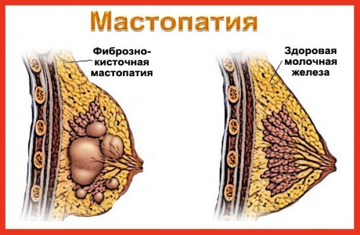 Healthy breasts and chest with mastopathy