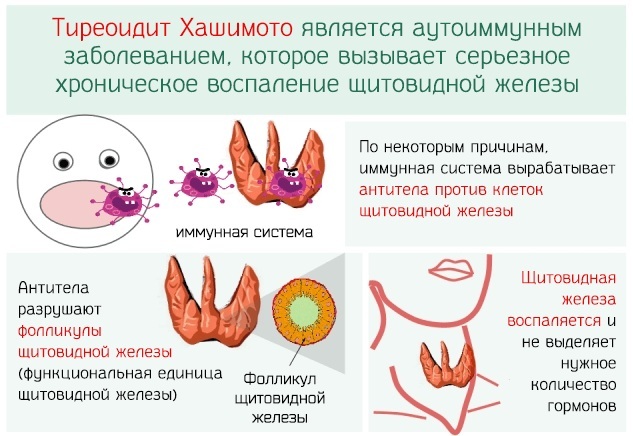 Kadik for women. Causes of appearance, photo of ultrasound, structure