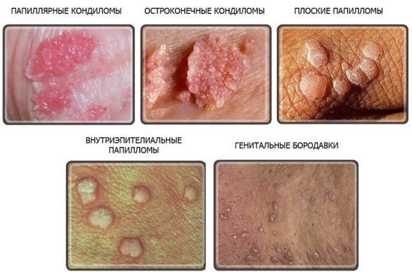 Human papillomavirus infection in women and men. Treatment, symptoms, as transmitted, manifest. Drugs