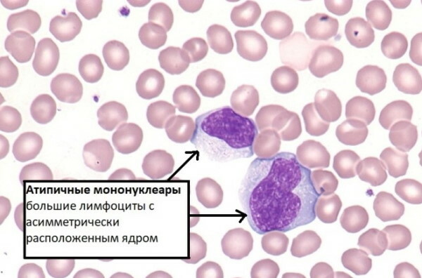 Atypical lymphocytes in a child's blood test. What does it mean