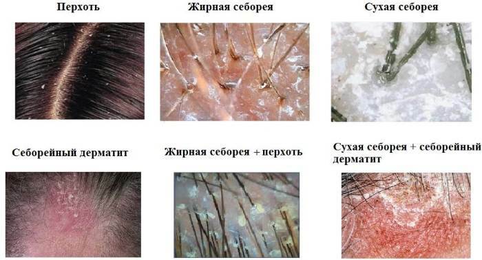 Seborrheic dermatitis on the head. Photo, treatment: ointments, non-hormonal creams, shampoos, drugs