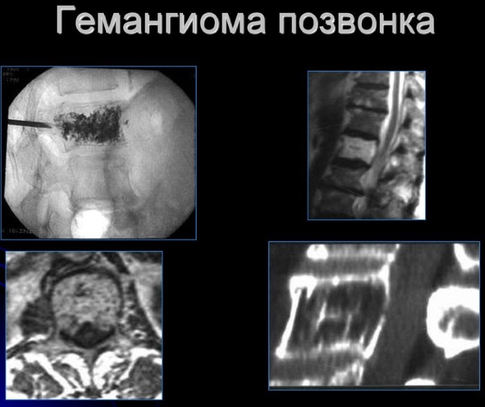 Vertebral hemangioma on MRI, CT, X-ray. What is it, consequences, treatment