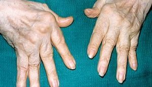 ochorenie artritídy