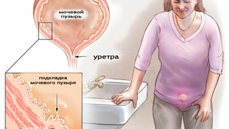 Inflammation of the urinary bladder in women